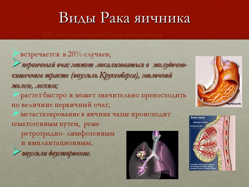 Виды Рака яичника Метастатический рак яичников  встречается  в 20% случаев; первичный очаг